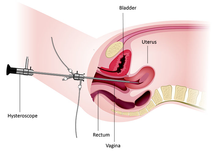 Biopsie endometriala