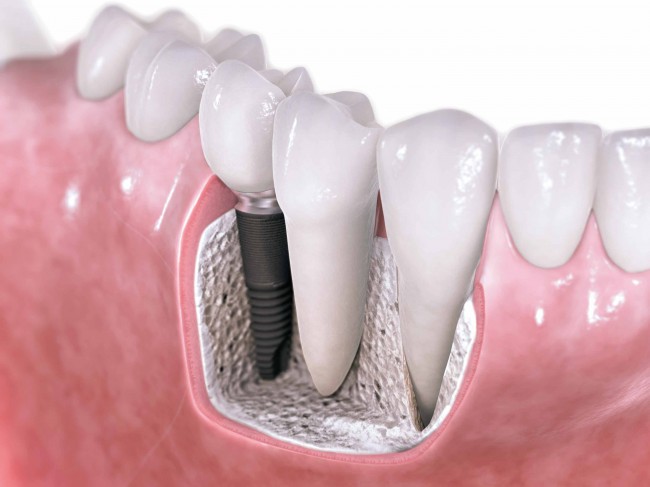 implant_dentar_cluj