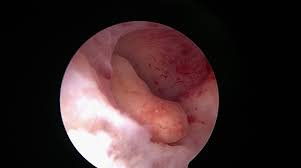Polip intrauterin