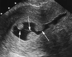 Polip intrauterin
