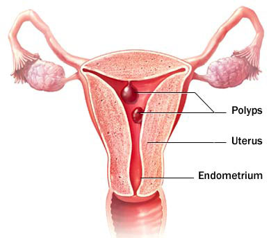 polipi-uterini-cluj
