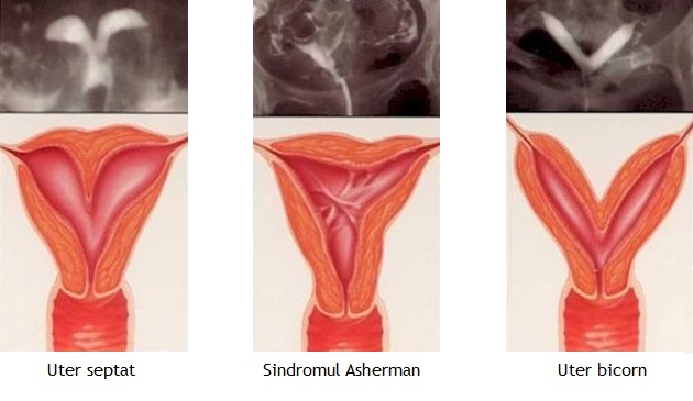 sinechie_uterina